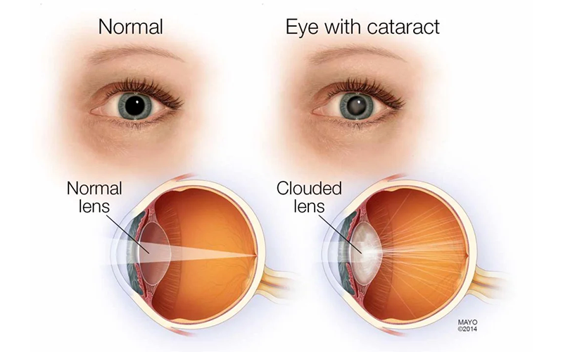 Common Eye Diseases in Patients